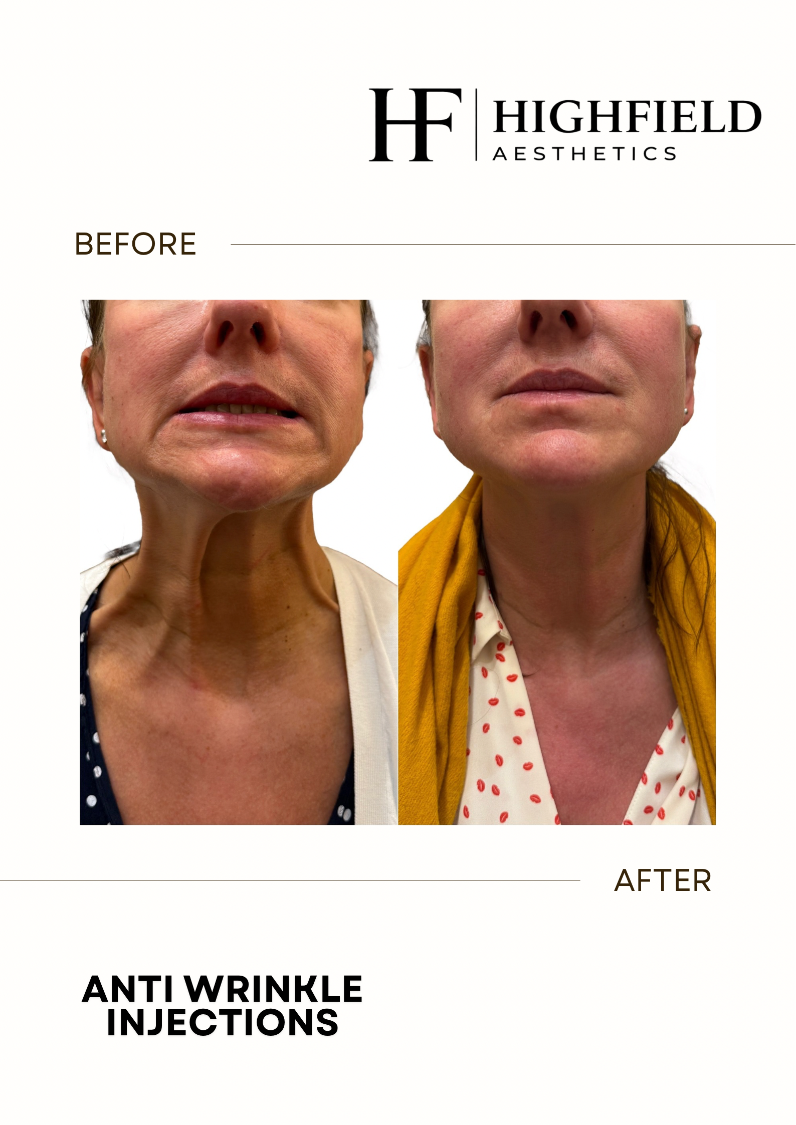 Before-and-after result: anti-wrinkle-neck-01.png