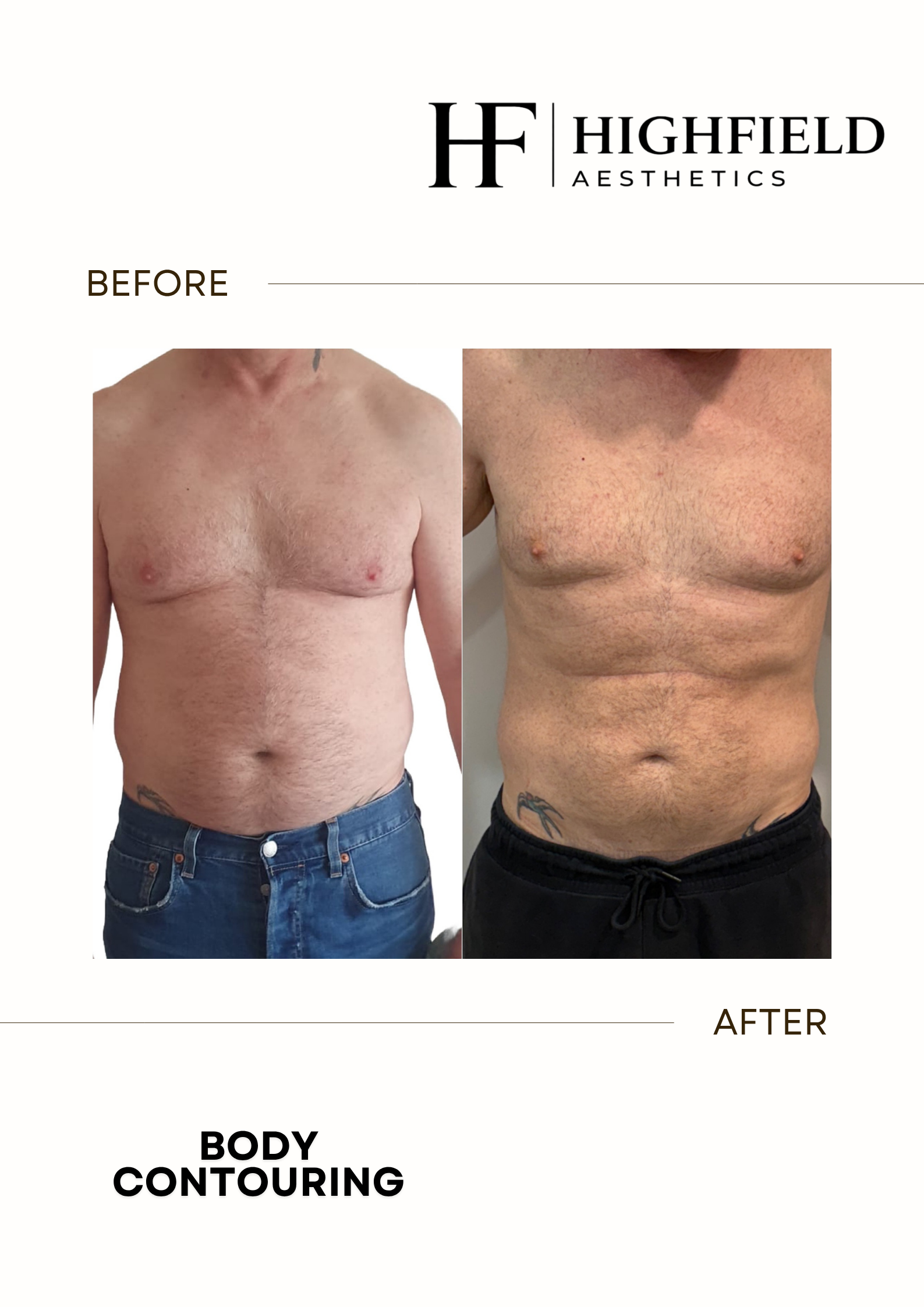 Before-and-after result: body-contouring-31.png