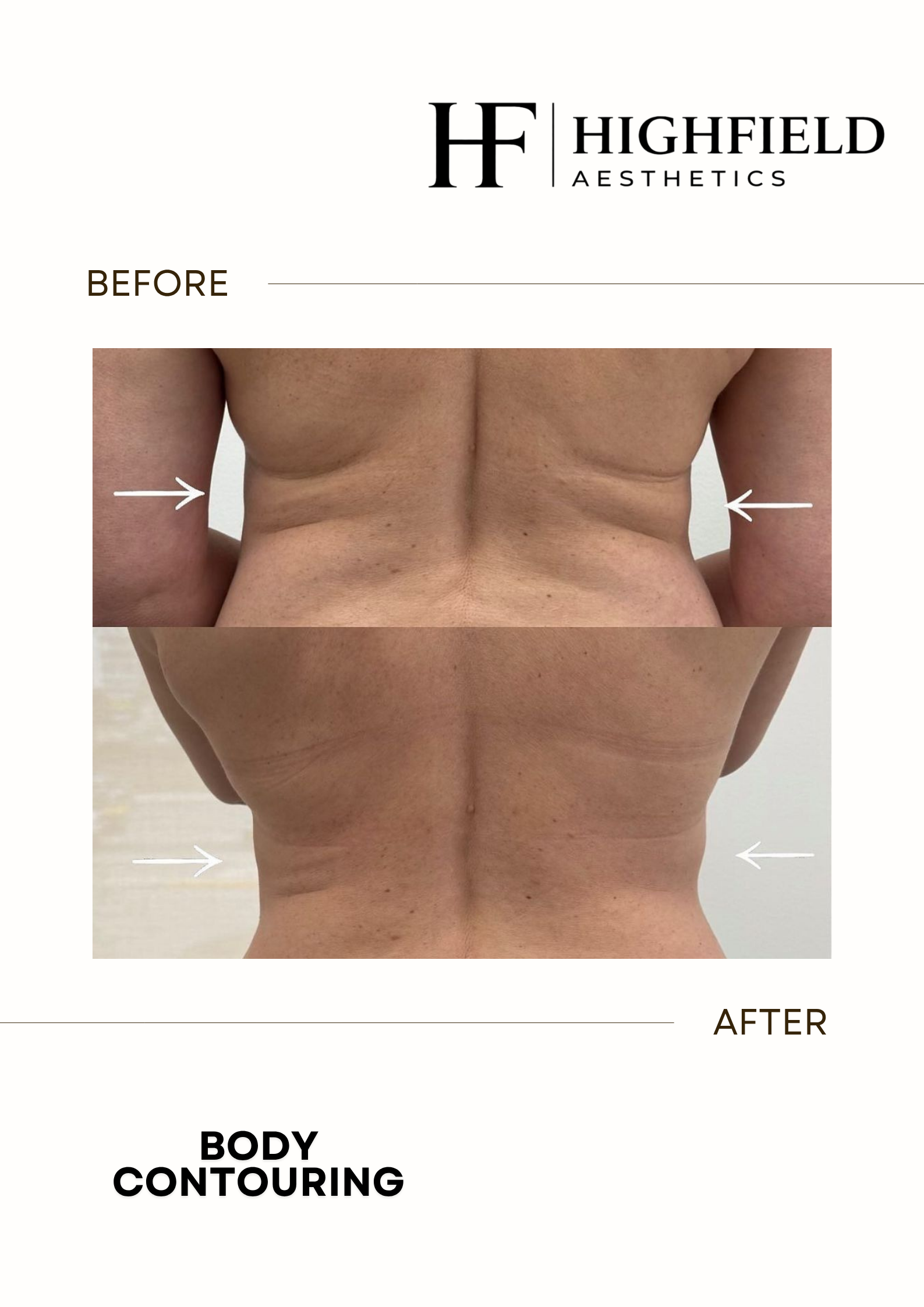 Before-and-after result: body-contouring-32.png