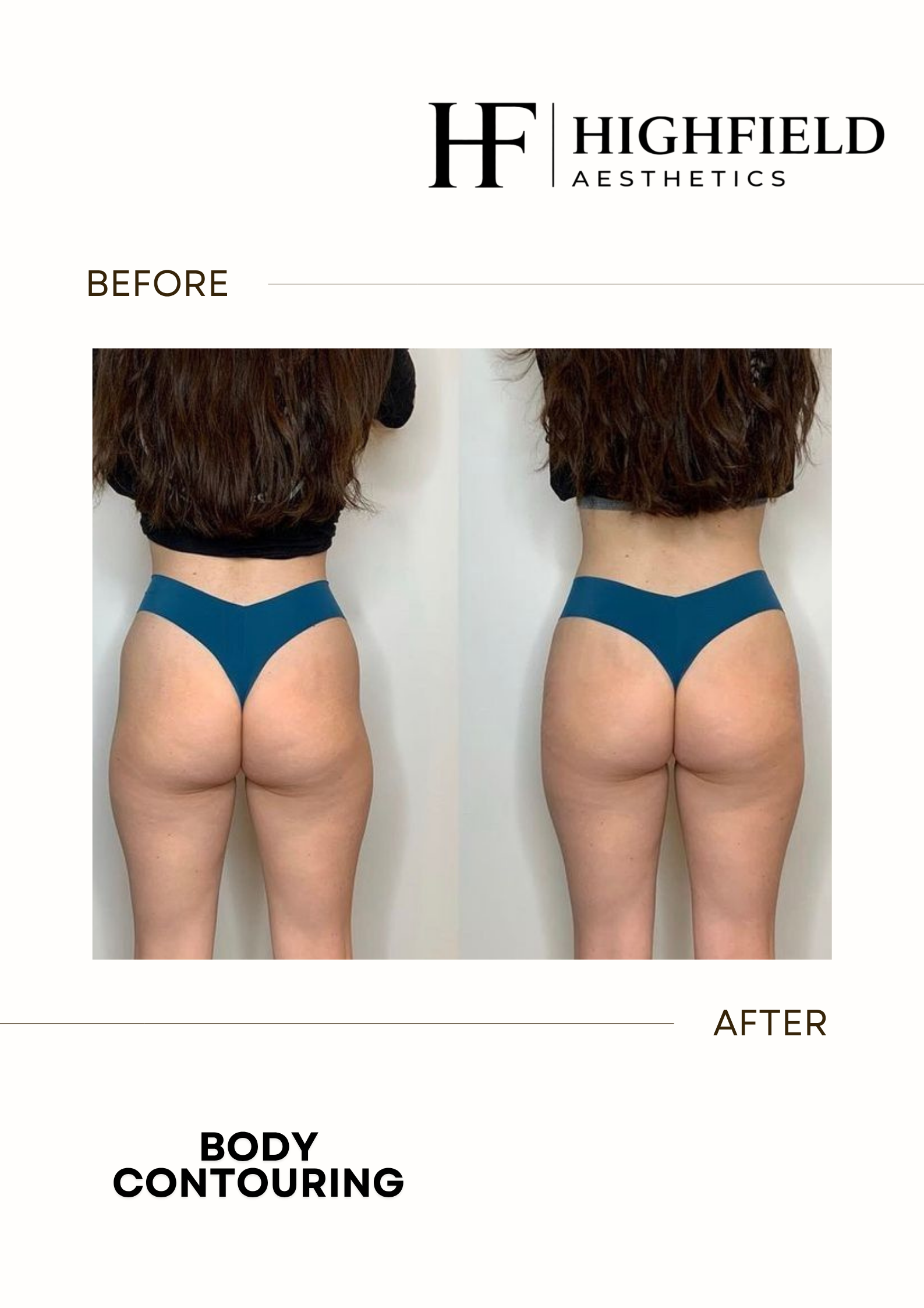 Before-and-after result: body-contouring-33.png