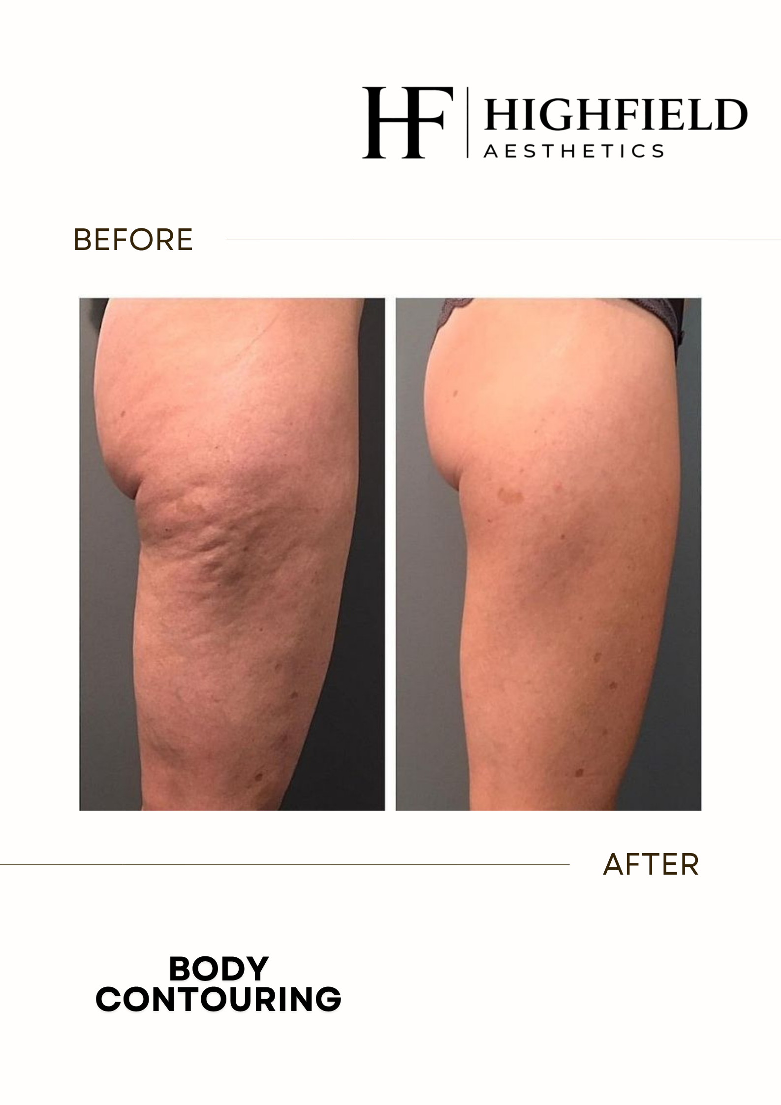 Before-and-after result: body-contouring-34.png