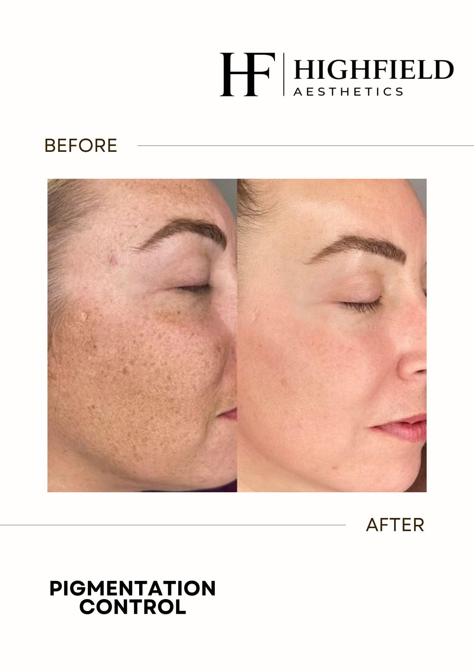 Before-and-after result: candela-pigmentation-13.png