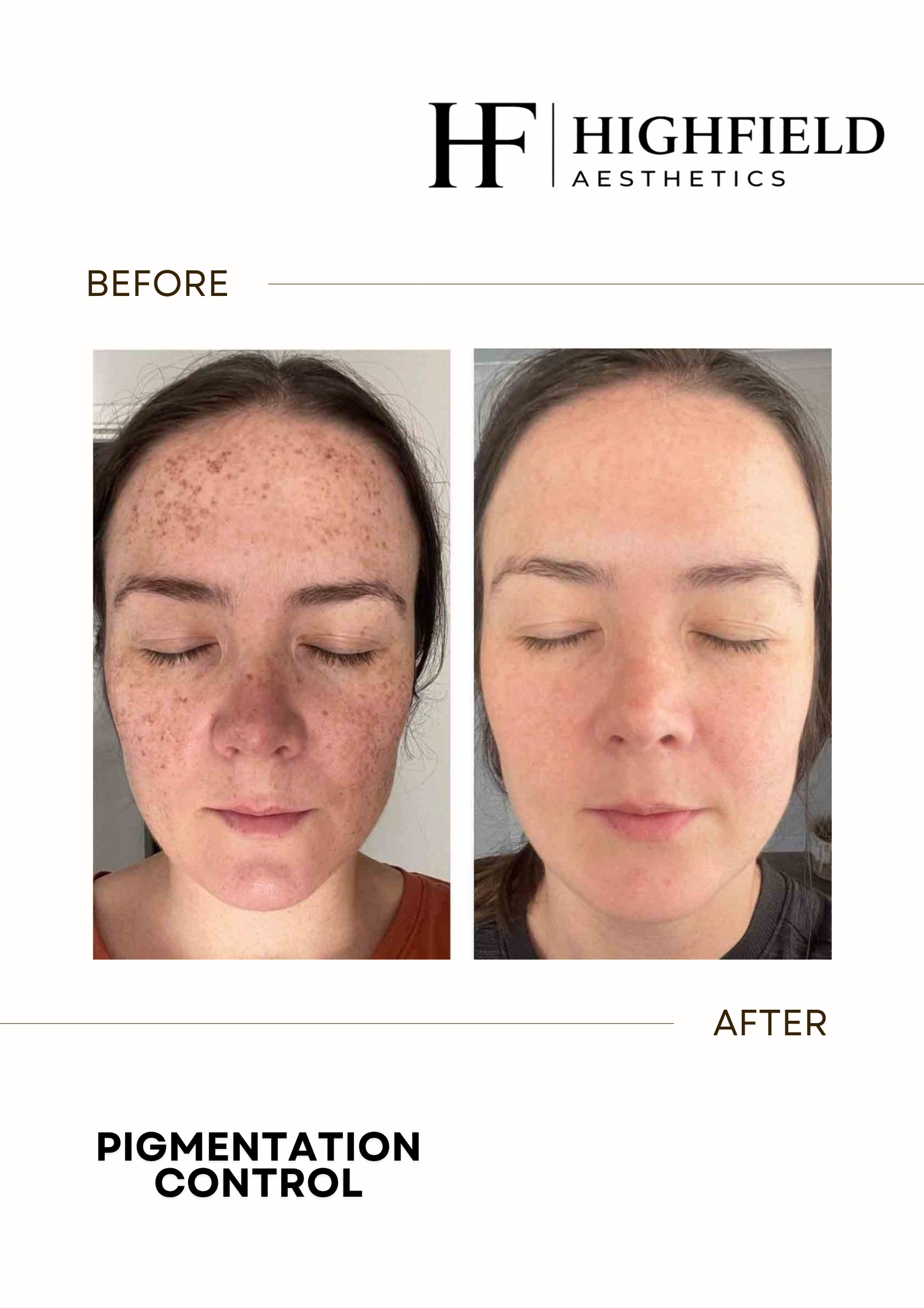 Before-and-after result: candela-pigmentation-14.png