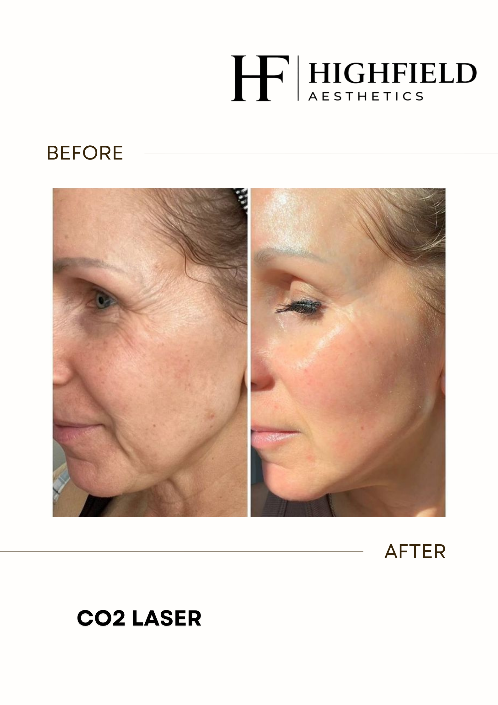 Before-and-after result: co2-laser-16.png