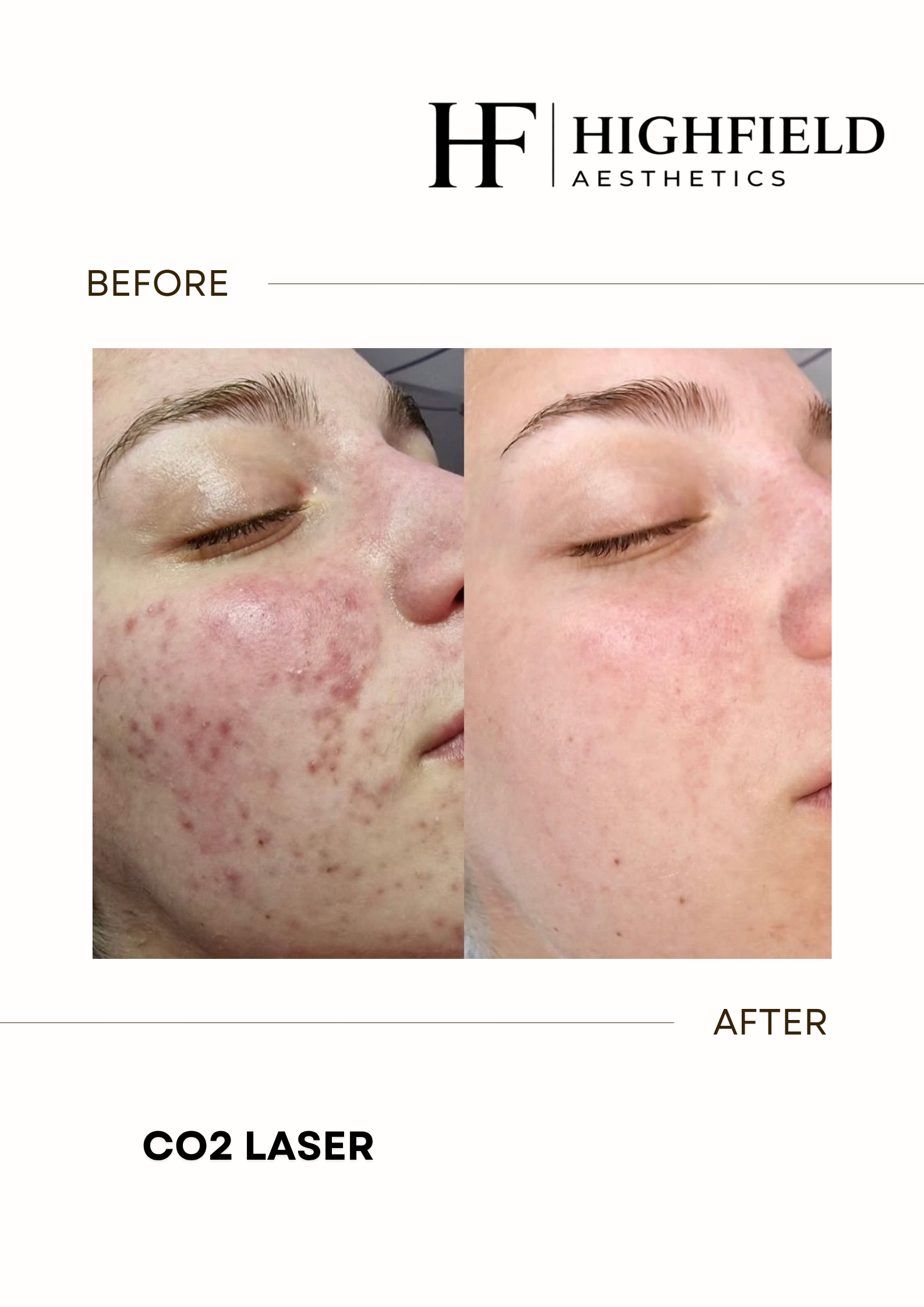 Before-and-after result: co2-laser-17.png