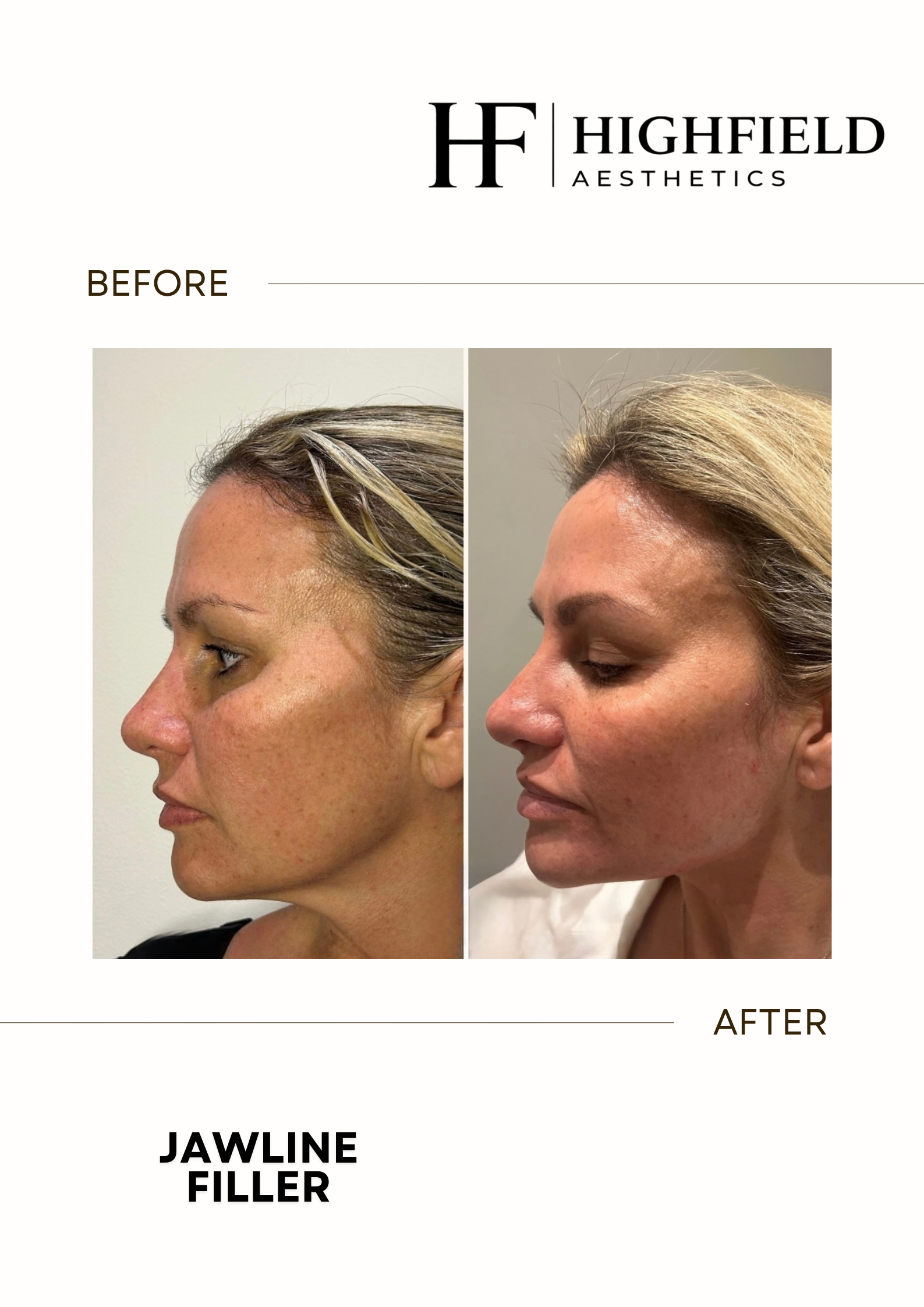 Before-and-after result: dermal-filler-01.png