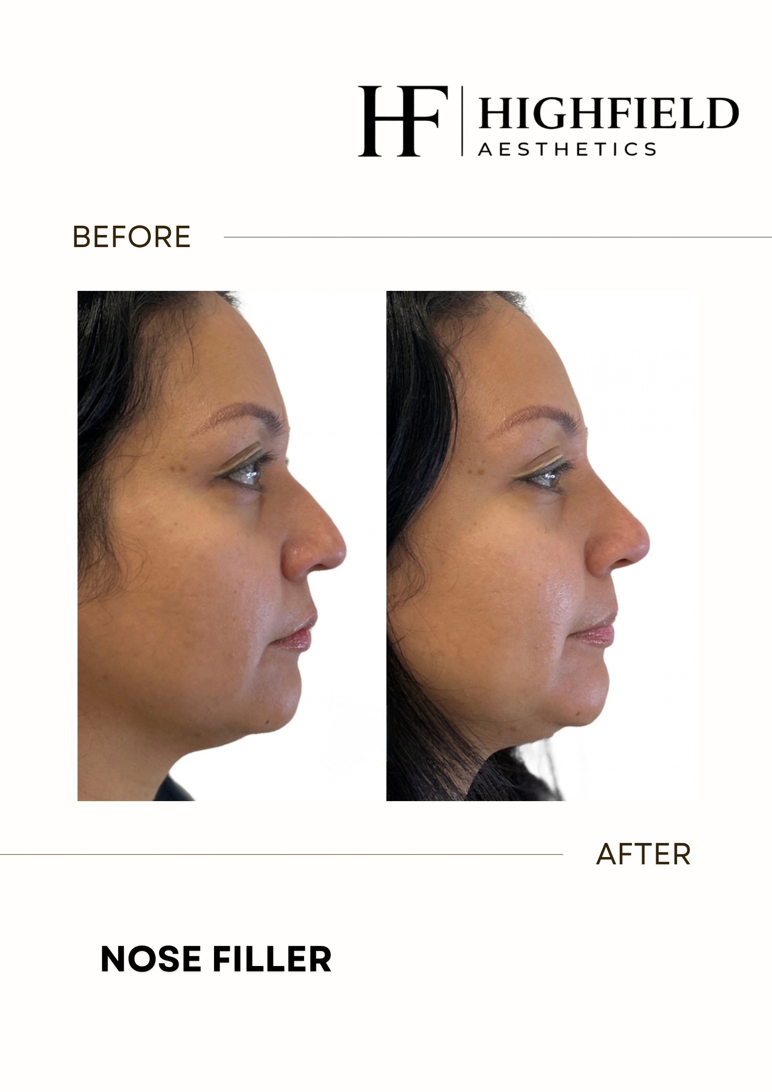 Before-and-after result: dermal-filler-02.png