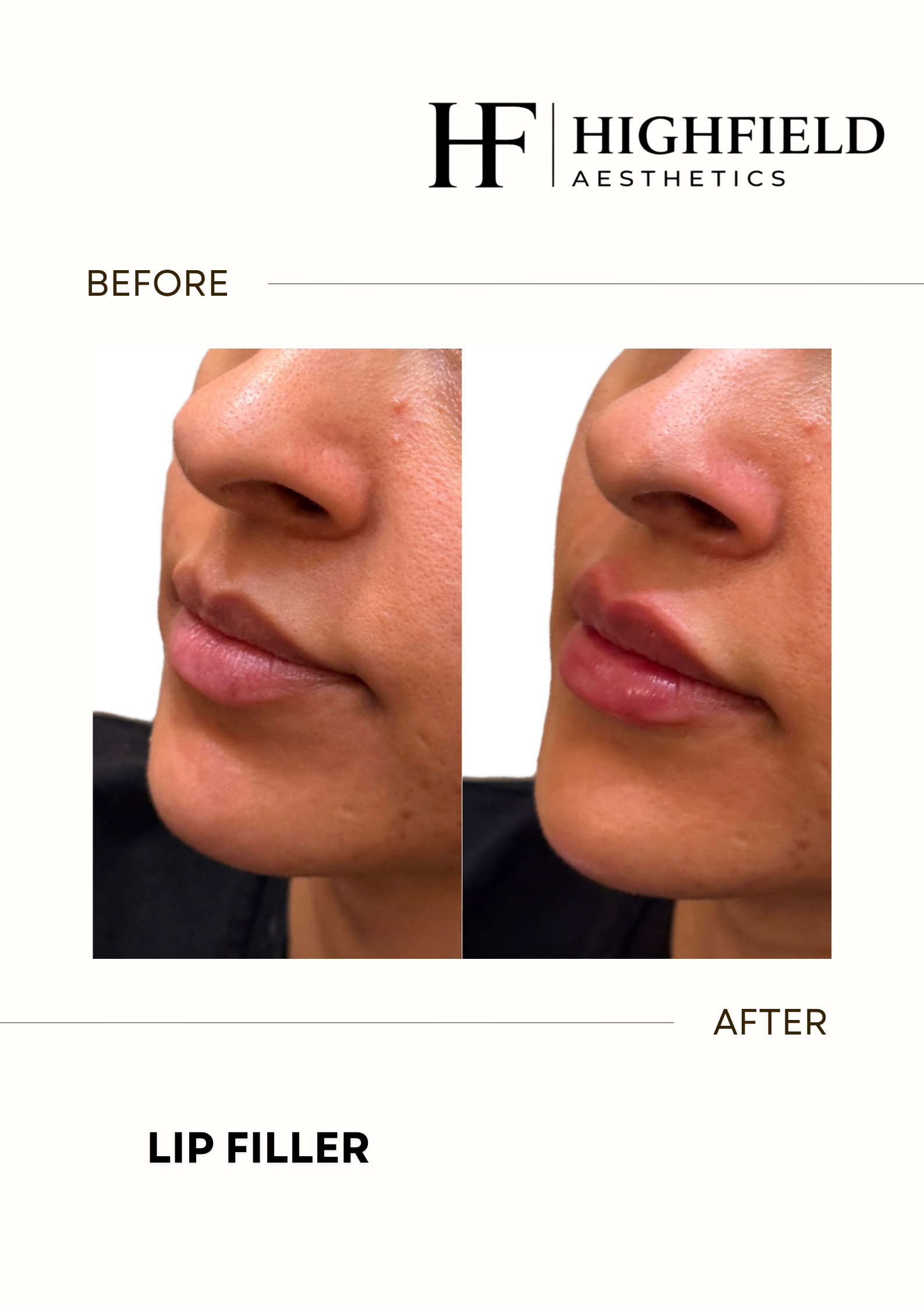 Before-and-after result: dermal-filler-03.png