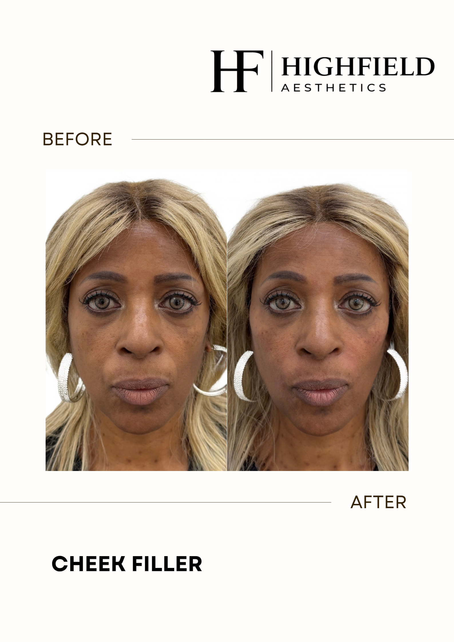 Before-and-after result: dermal-filler-04.png