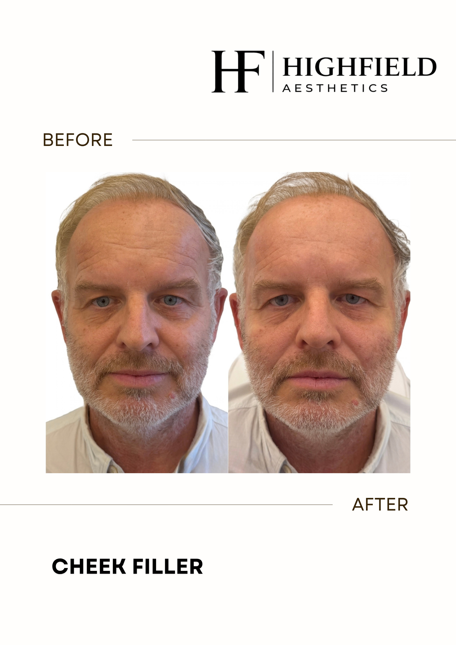 Before-and-after result: dermal-filler-05.png