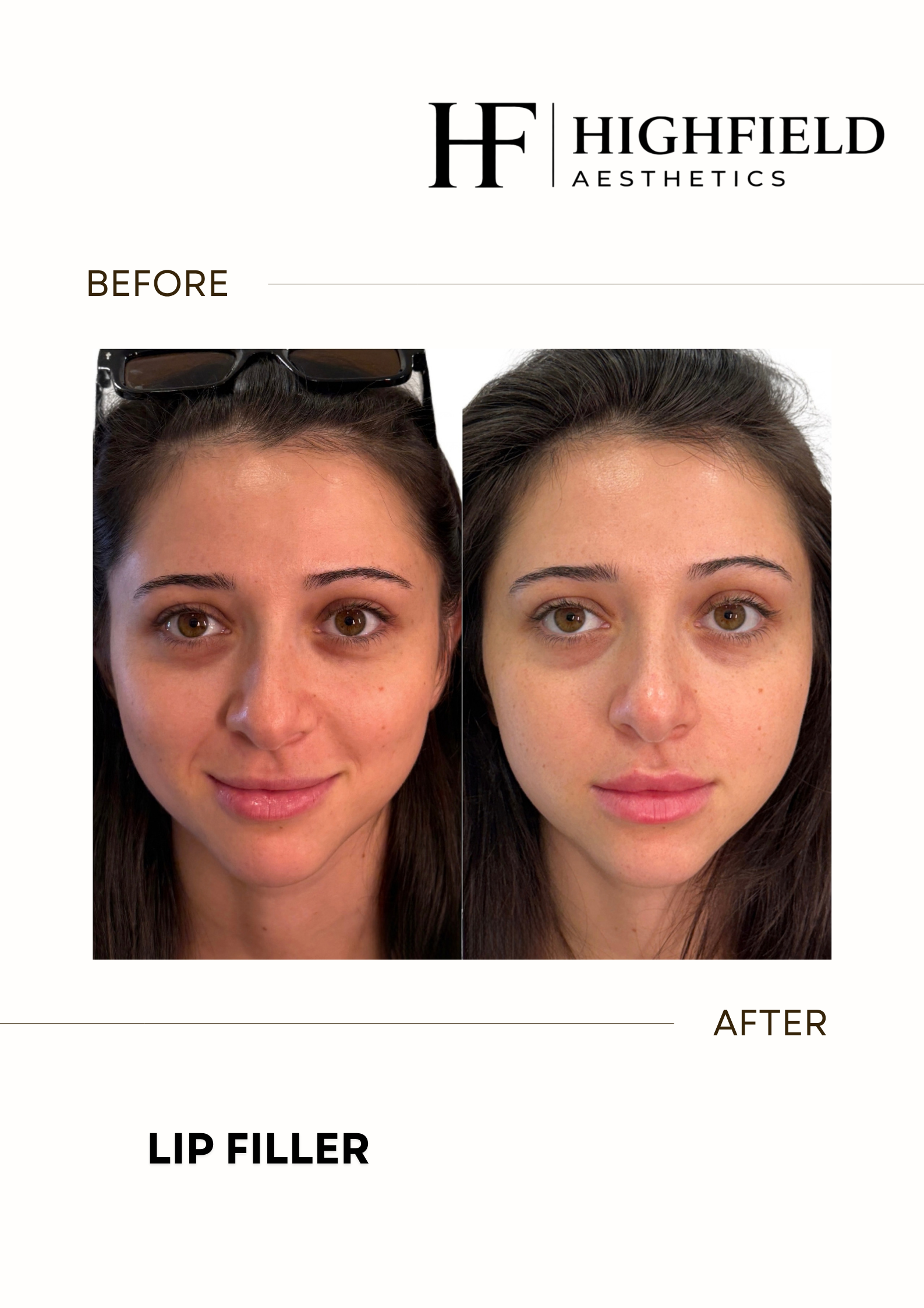 Before-and-after result: dermal-filler-06.png