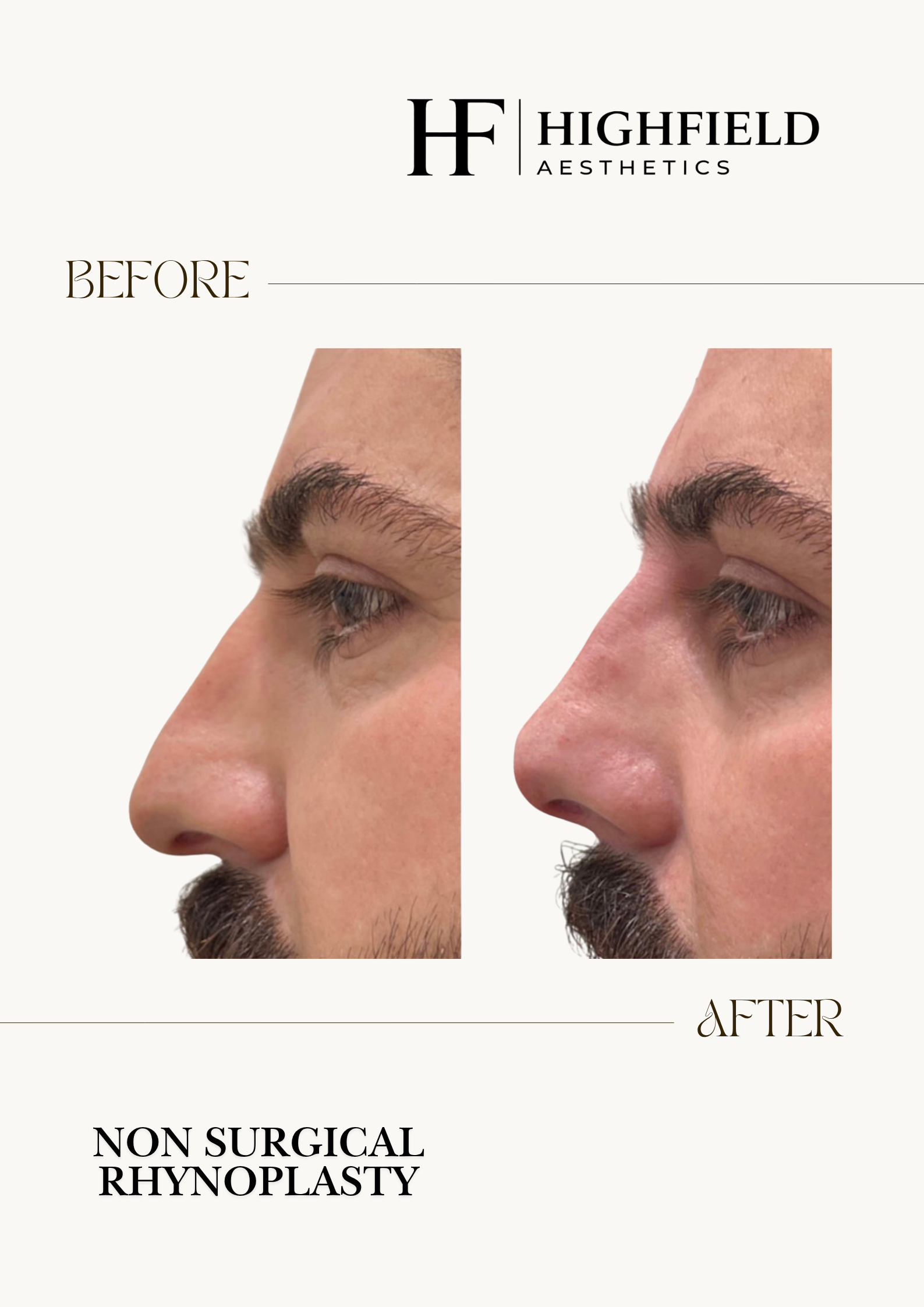Before-and-after result: dermal-filler-img-4148.png