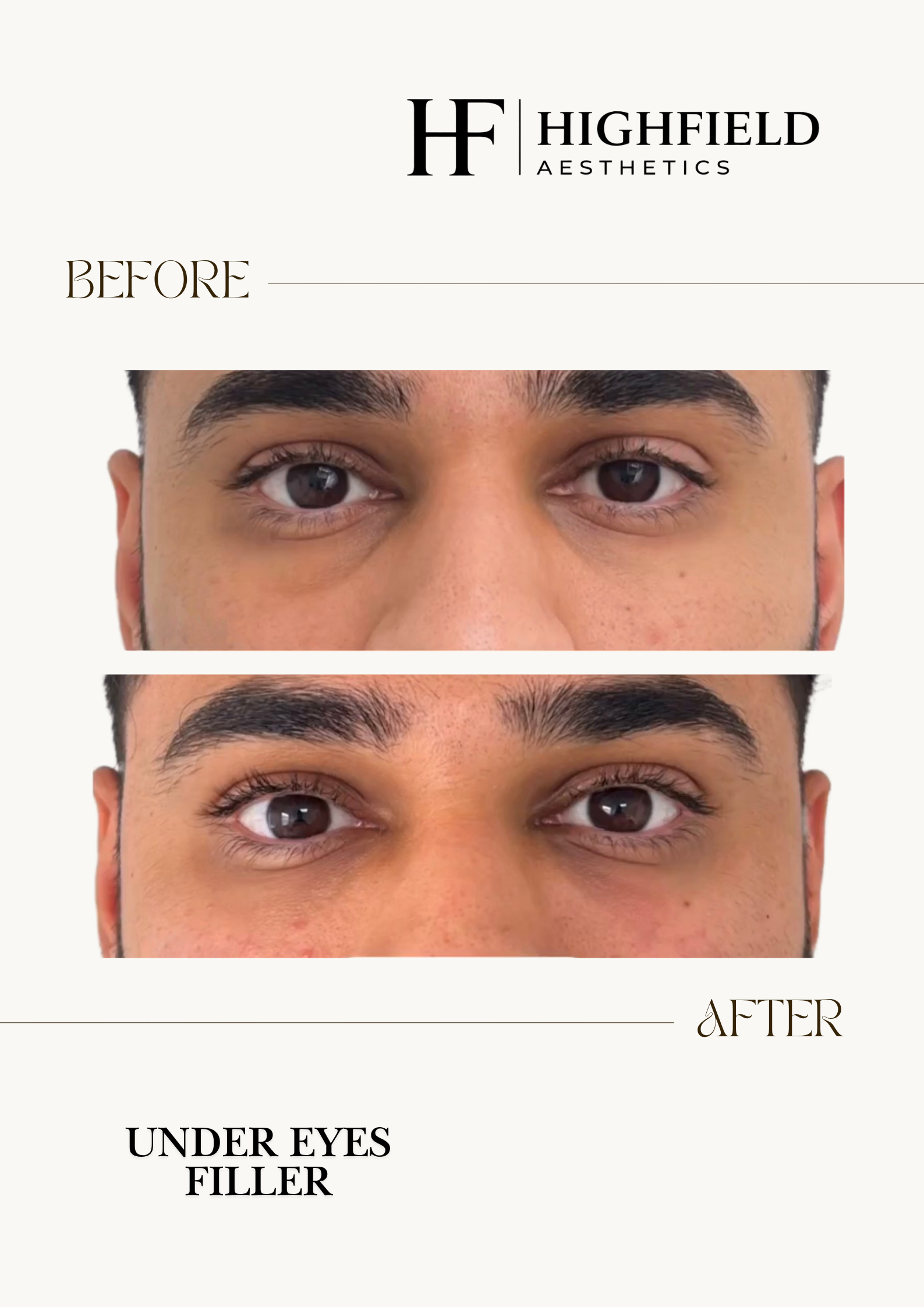 Before-and-after result: dermal-filler-img-4156.png