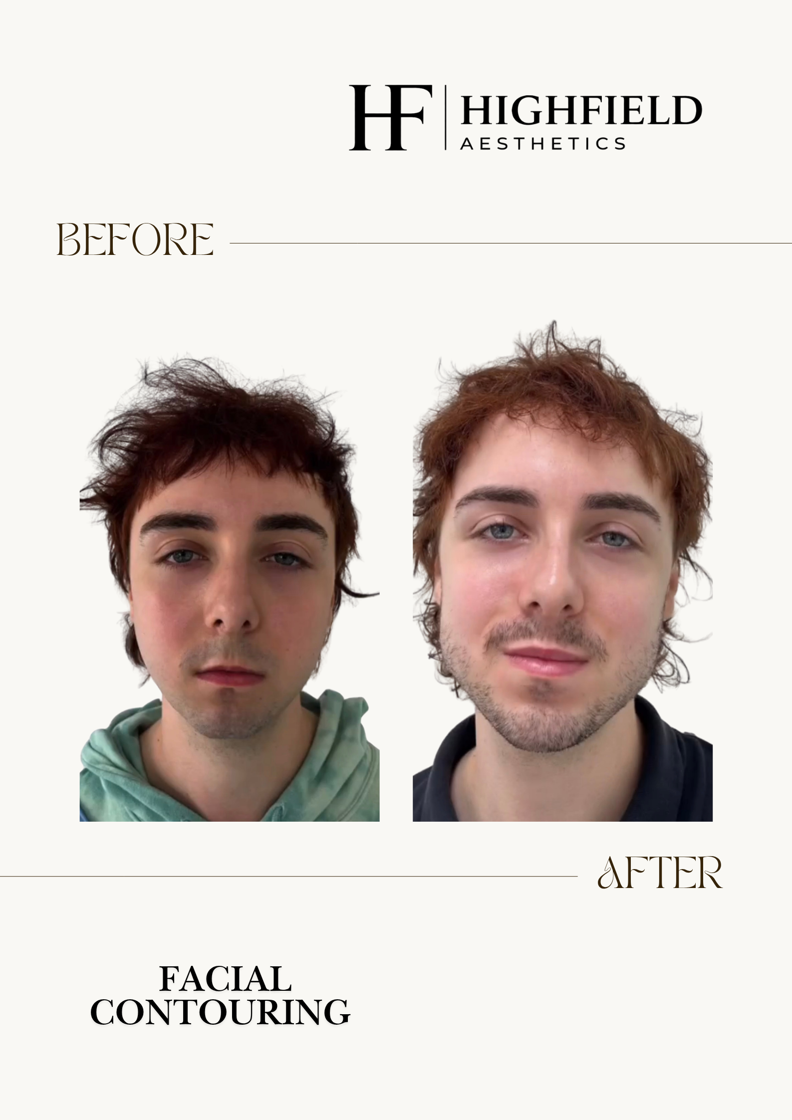 Before-and-after result: dermal-filler-img-4164.png