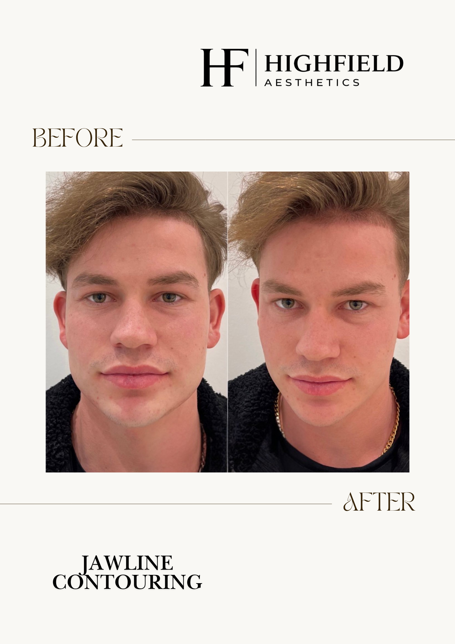 Before-and-after result: dermal-filler-img-4188.png