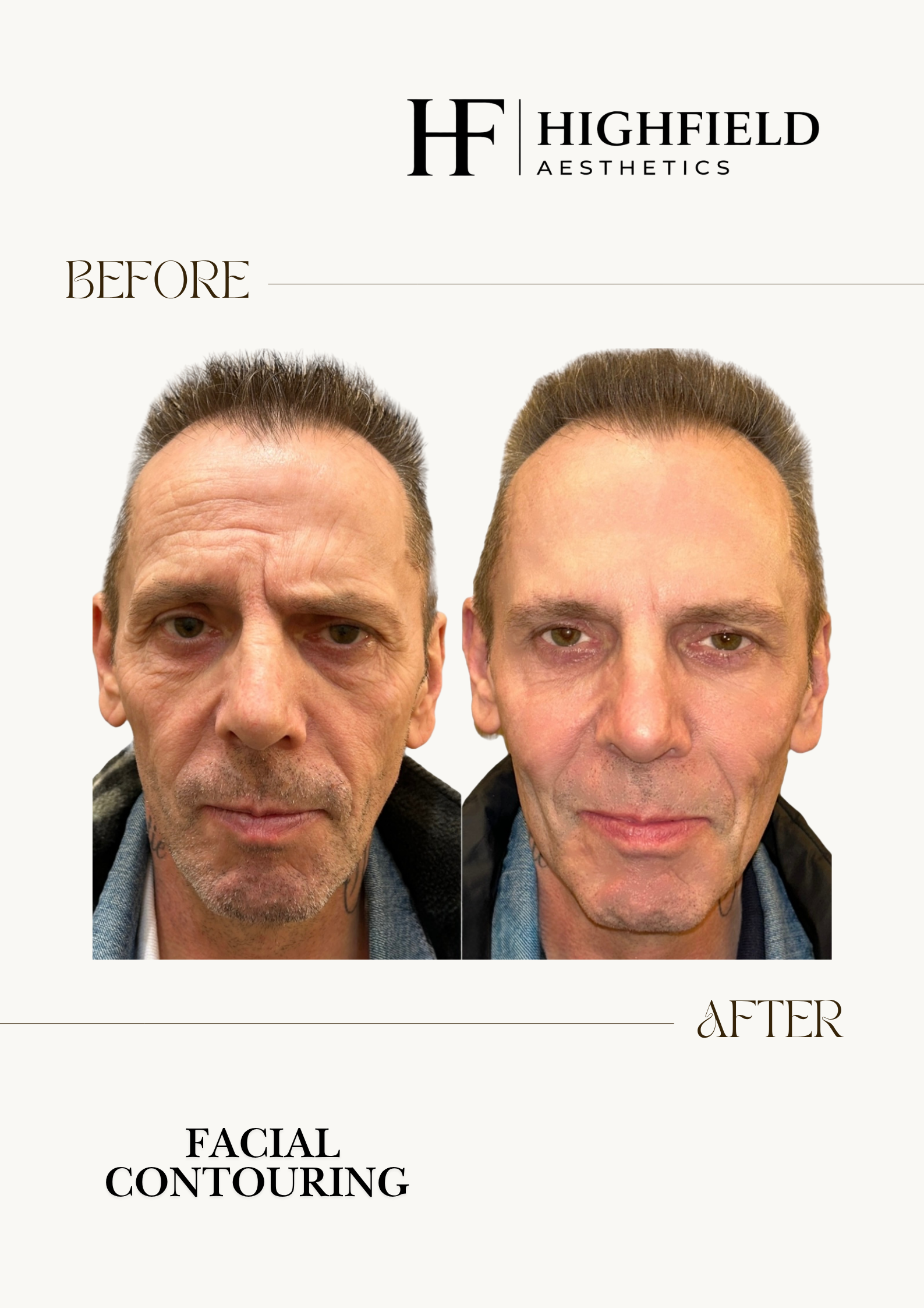 Before-and-after result: dermal-filler-img-4199.png