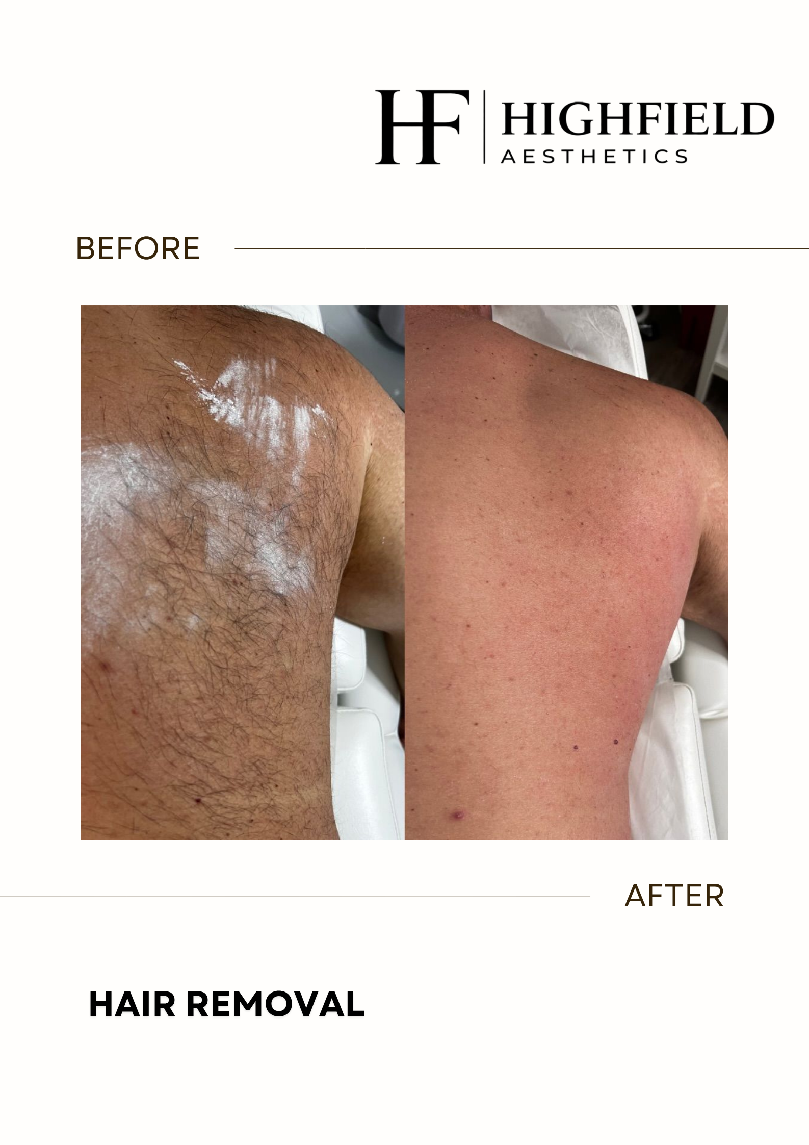 Before-and-after result: hair-removal-29.png