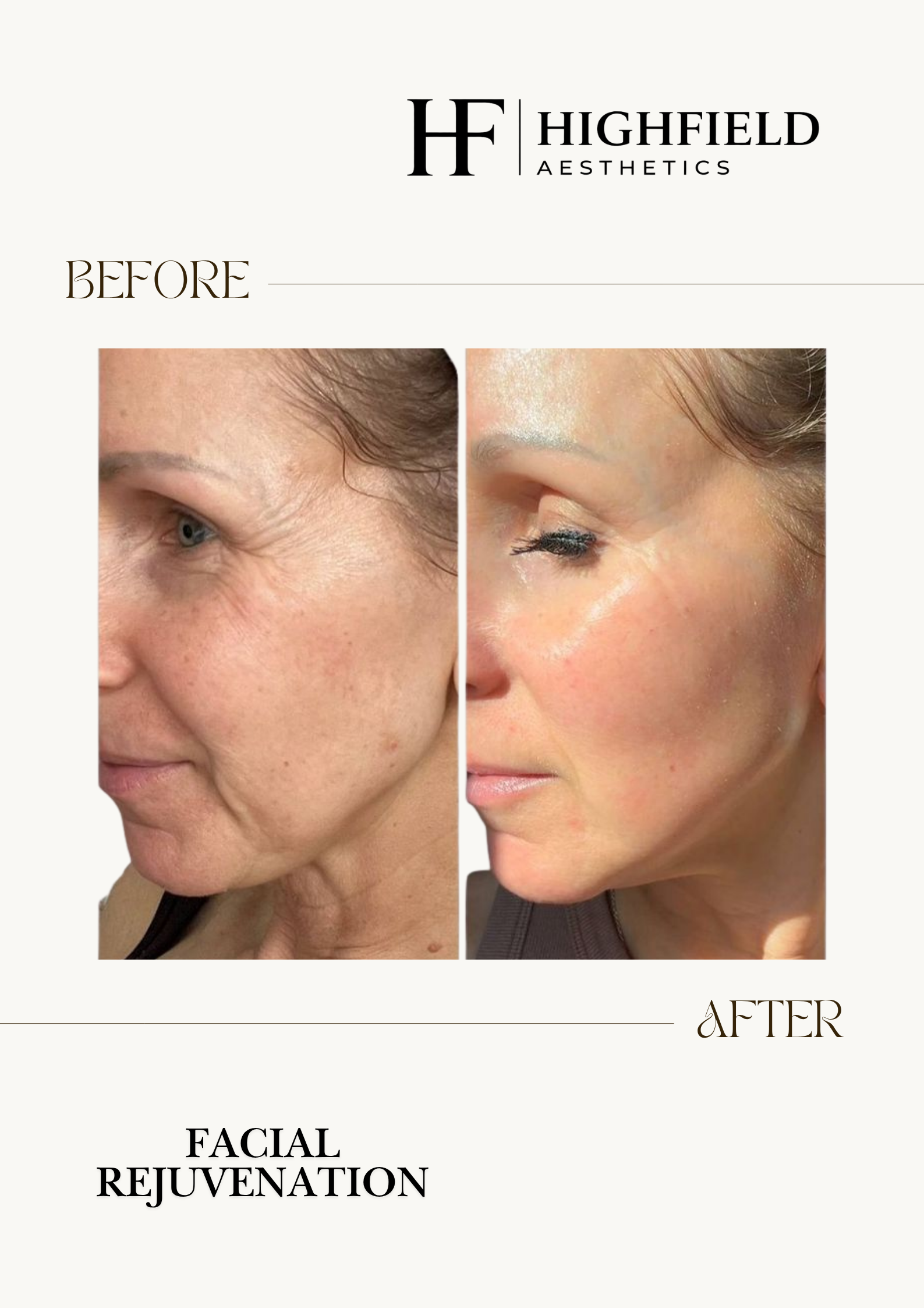 Before-and-after result: CO2 laser skin rejuvenation