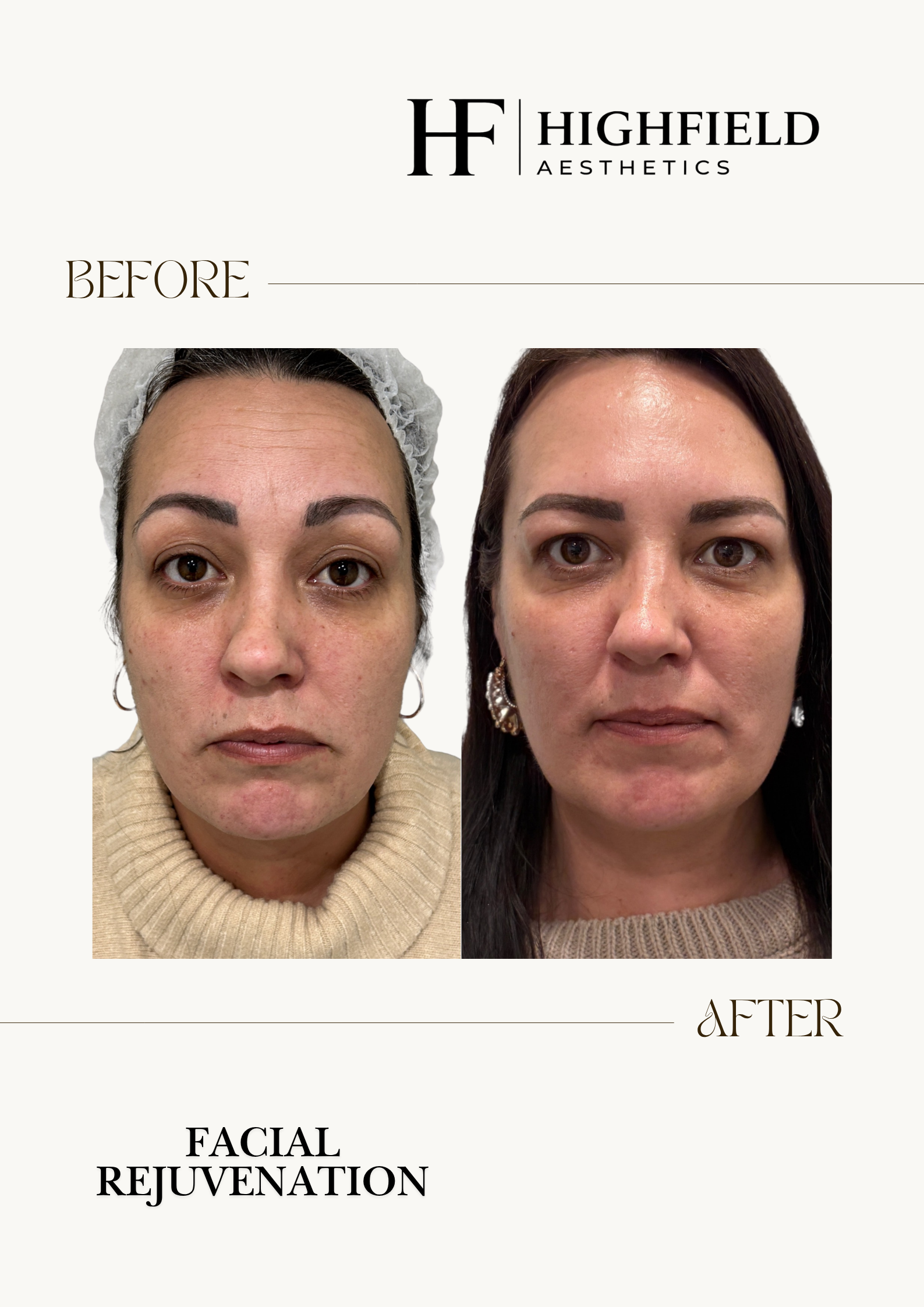 Before and after: Facial rejuvenation. Before on the left, after on the right.