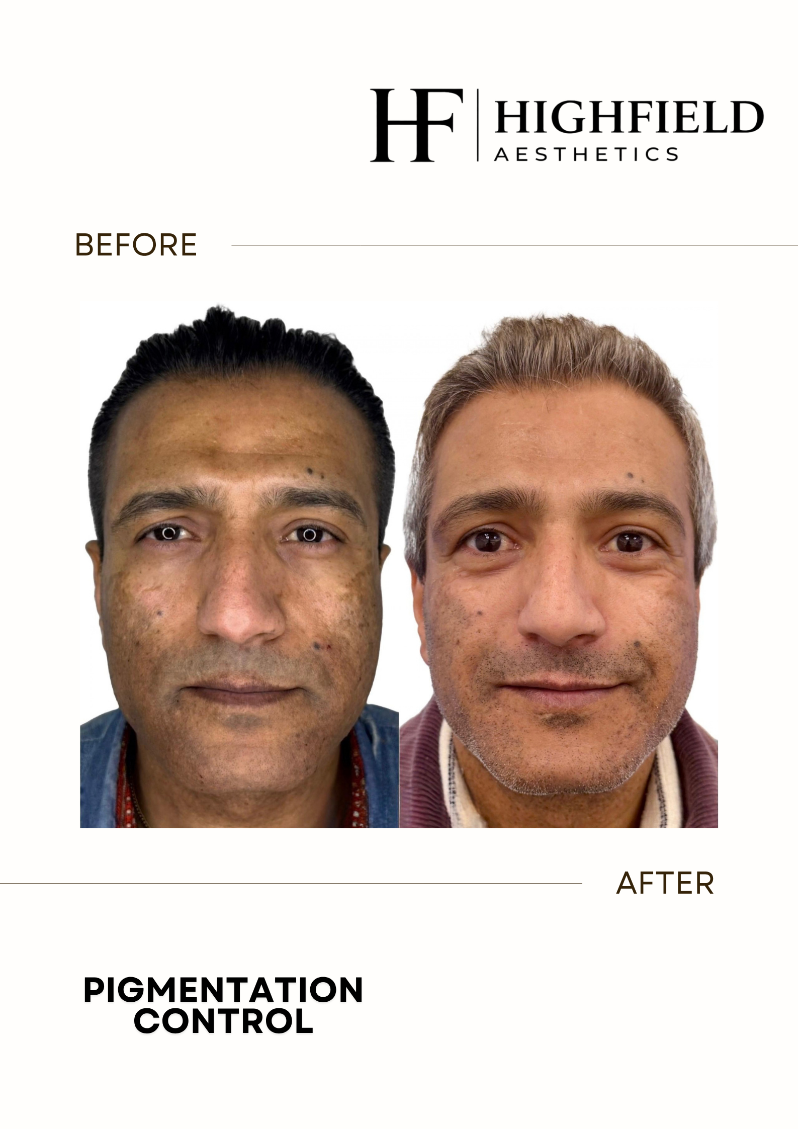 Before-and-after result: pigmentation-12.png