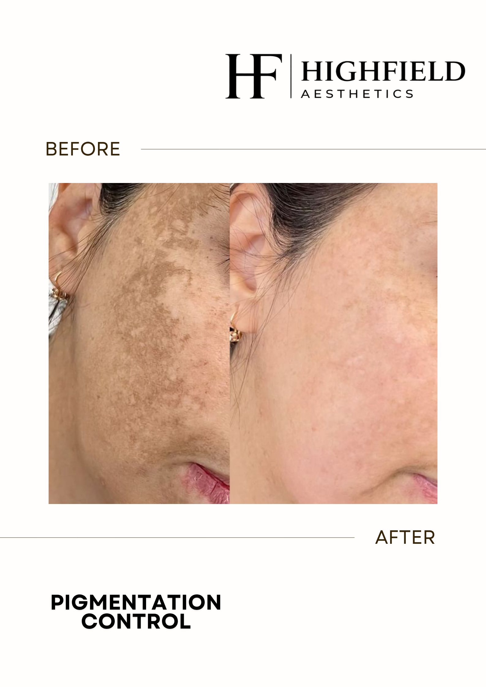 Before-and-after result: pigmentation-15.png