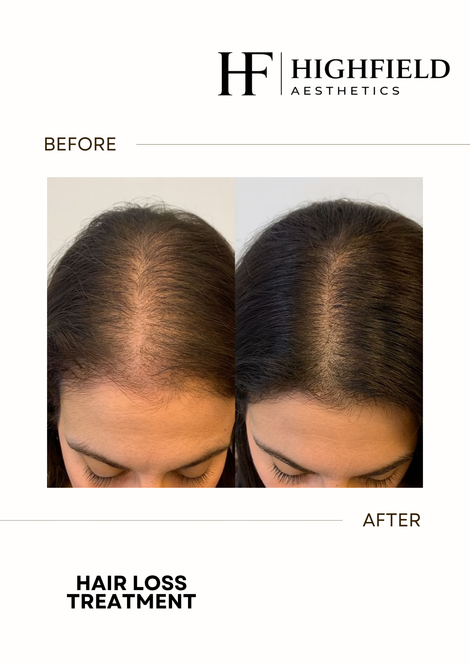 Before-and-after result: prp-hair-loss-36.png