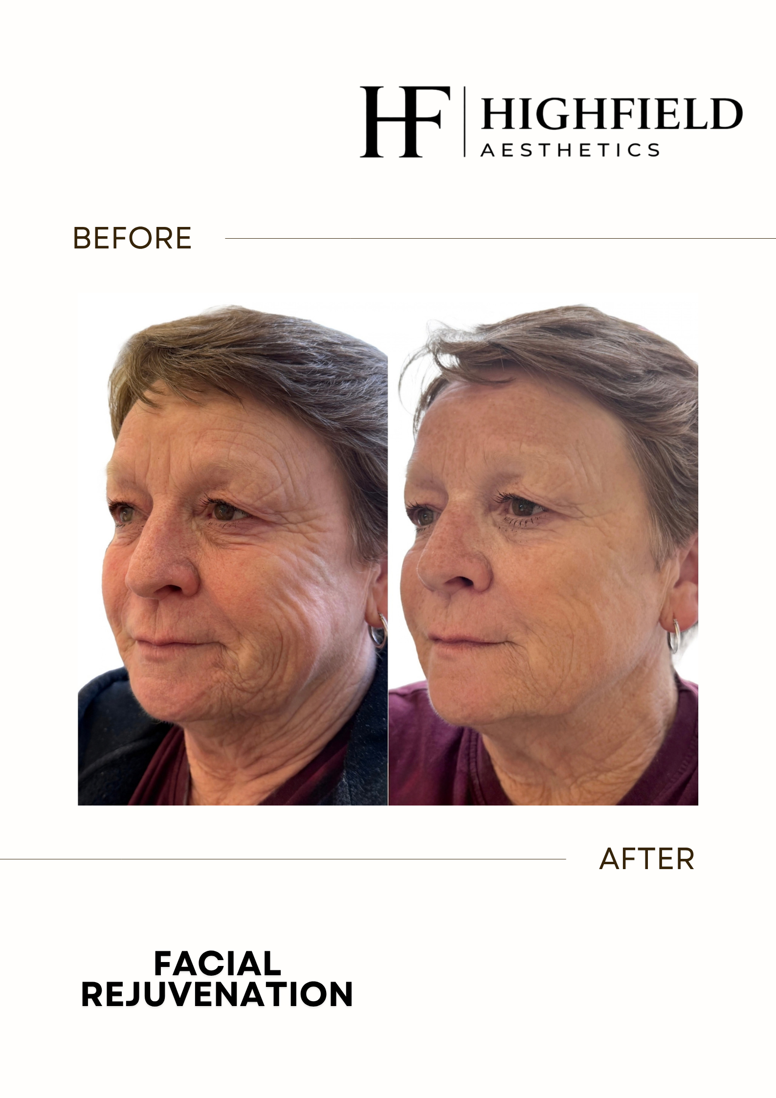 Before-and-after result: skin-rejuvenation-06.png