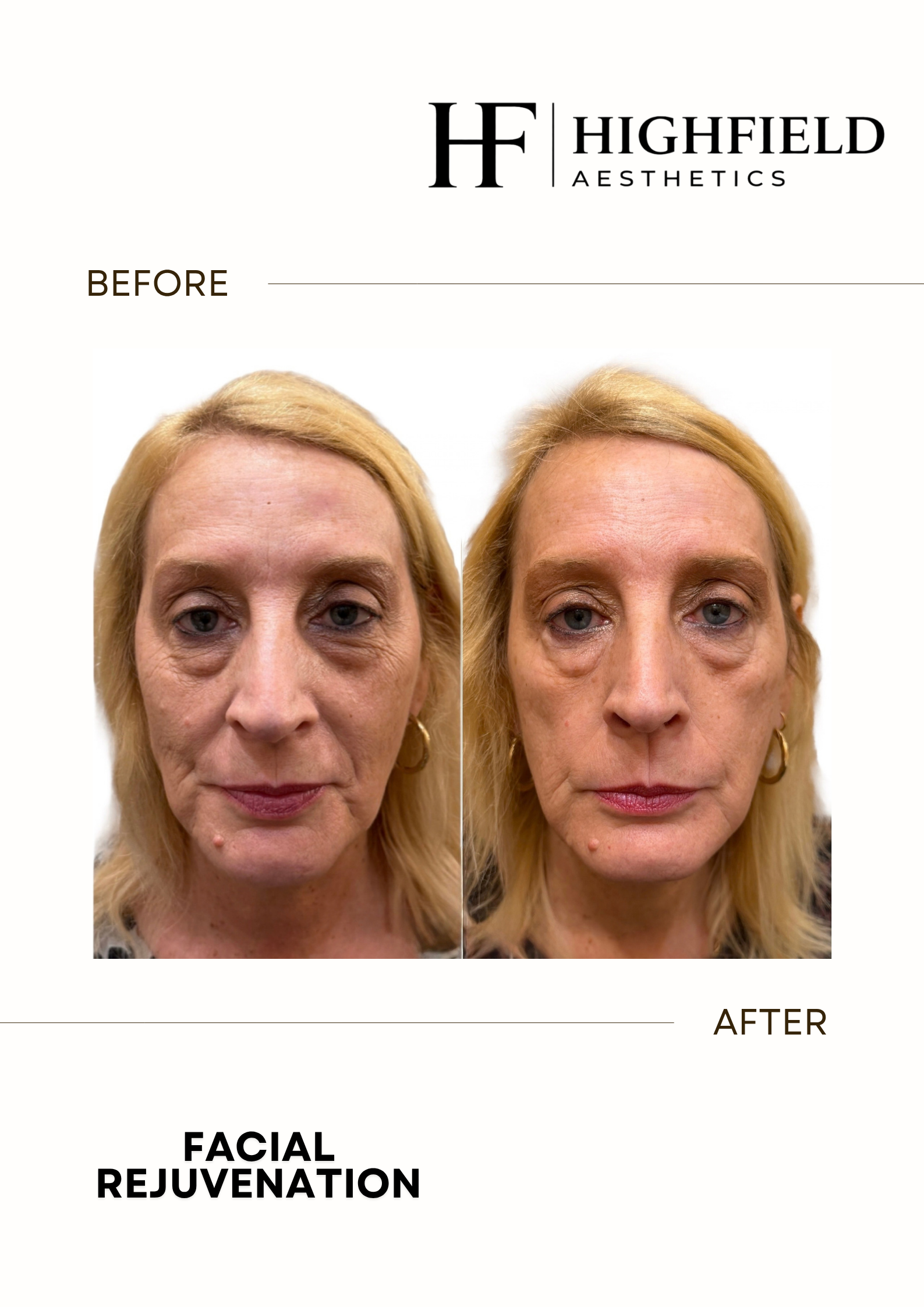 Before-and-after result: skin-rejuvenation-07.png