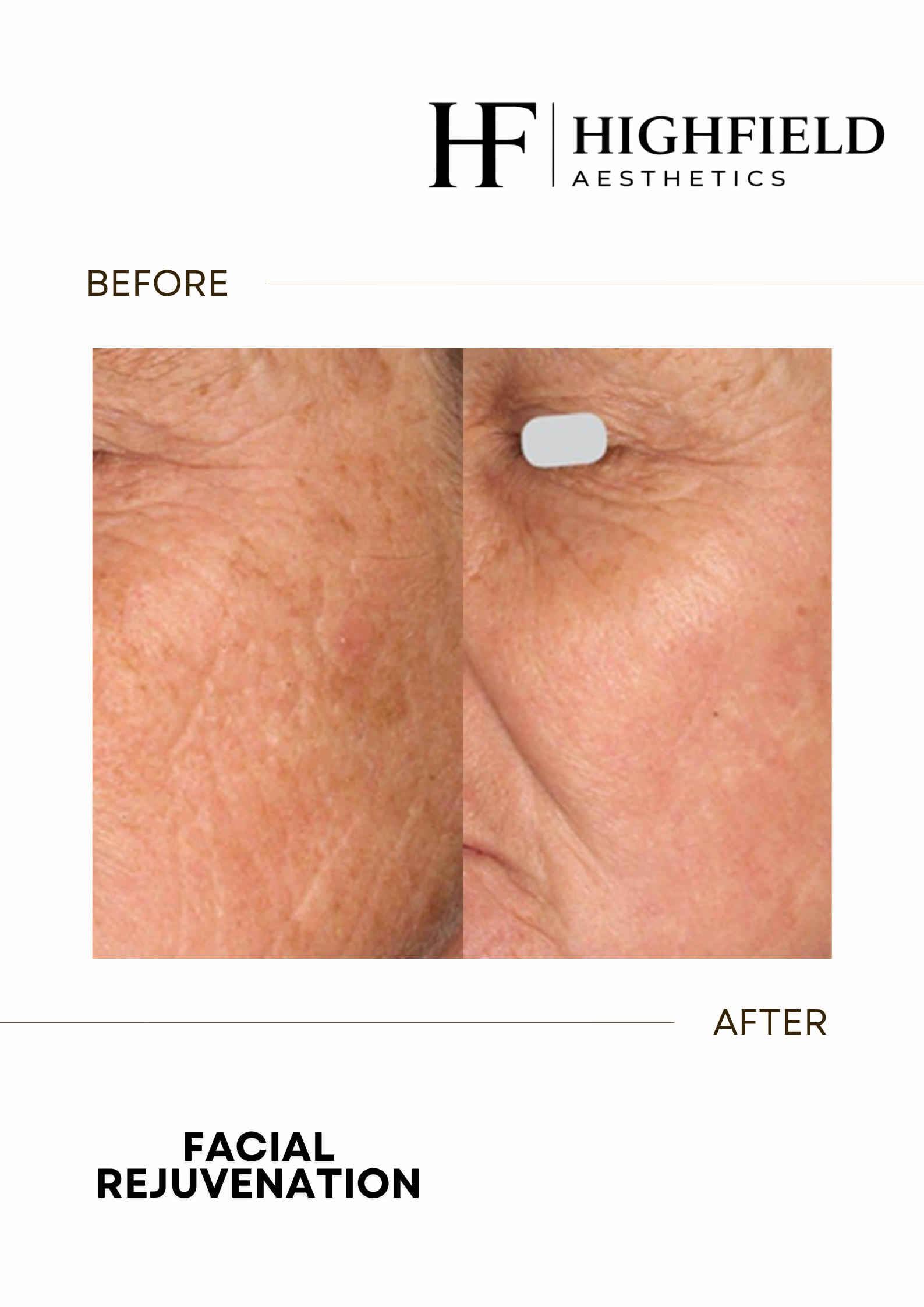 Before-and-after result: skin-rejuvenation-10.png