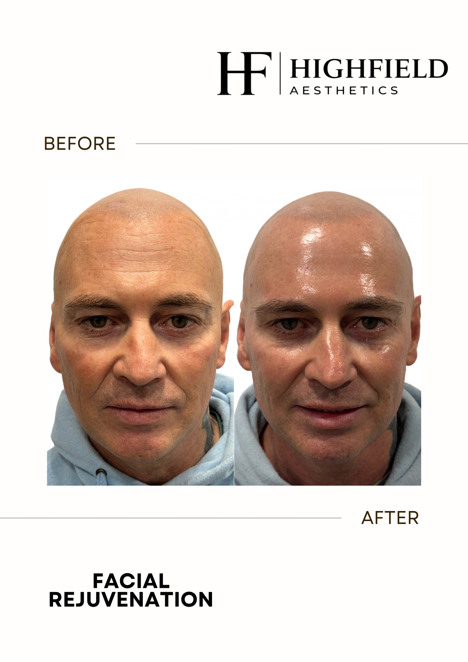 Before-and-after result: skin-rejuvenation-11.png